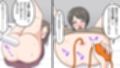 肛門ホクロ検査